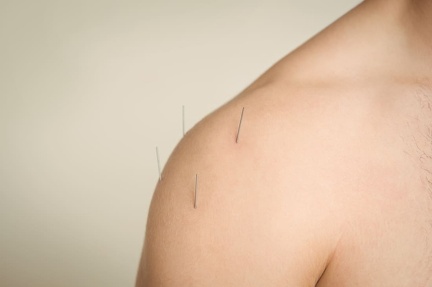 close-up-patient-getting-dry-needling